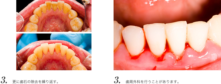 3.更に歯石の除去を繰り返す。3.歯周外科を行うことがあります。